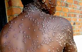 MERCREDI SANTÉ/ VARIOLE DU SINGE: Tout savoir sur le «virus Mpox» avec le Docteur Alassane Akpaki