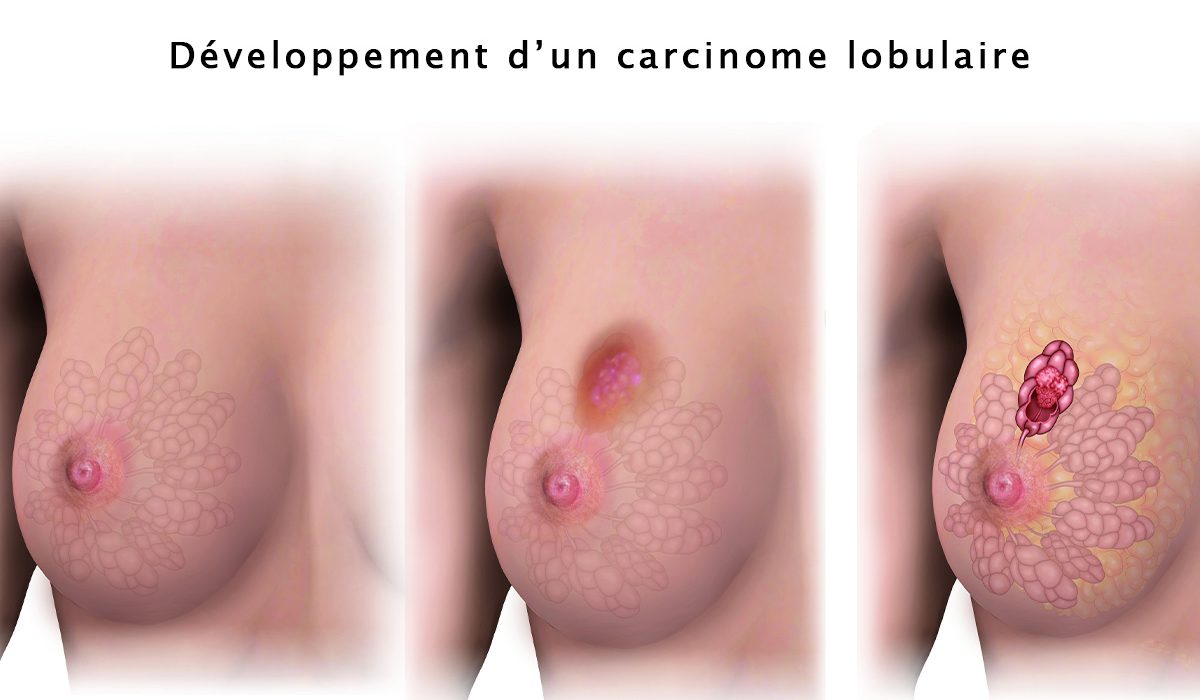OCTOBRE ROSE : La sage-femme Maman Mounaya rappelle l’importance du dépistage précoce et appelle à briser les tabous